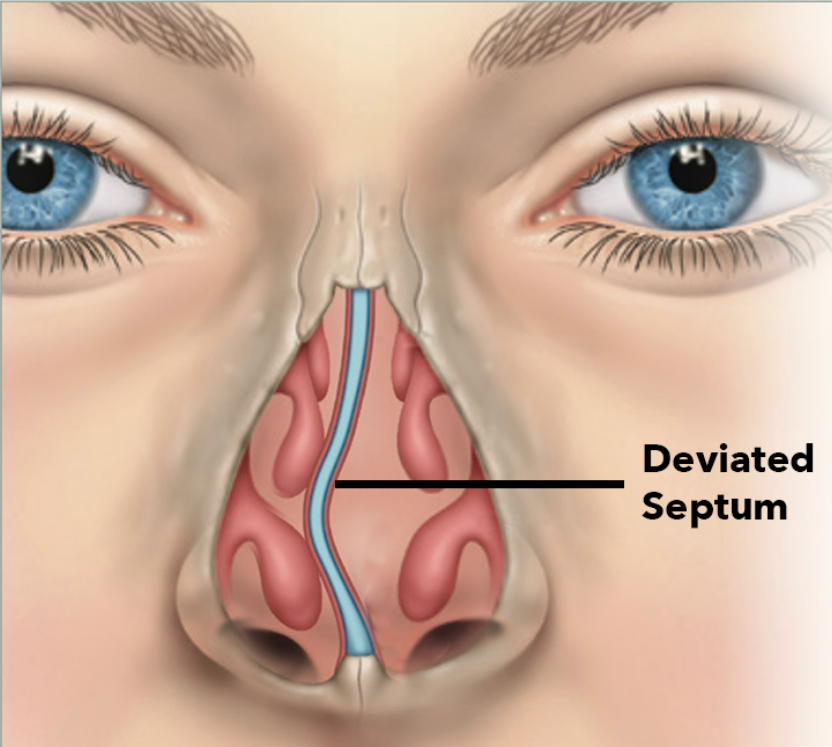 Septoplasty and septal deviation